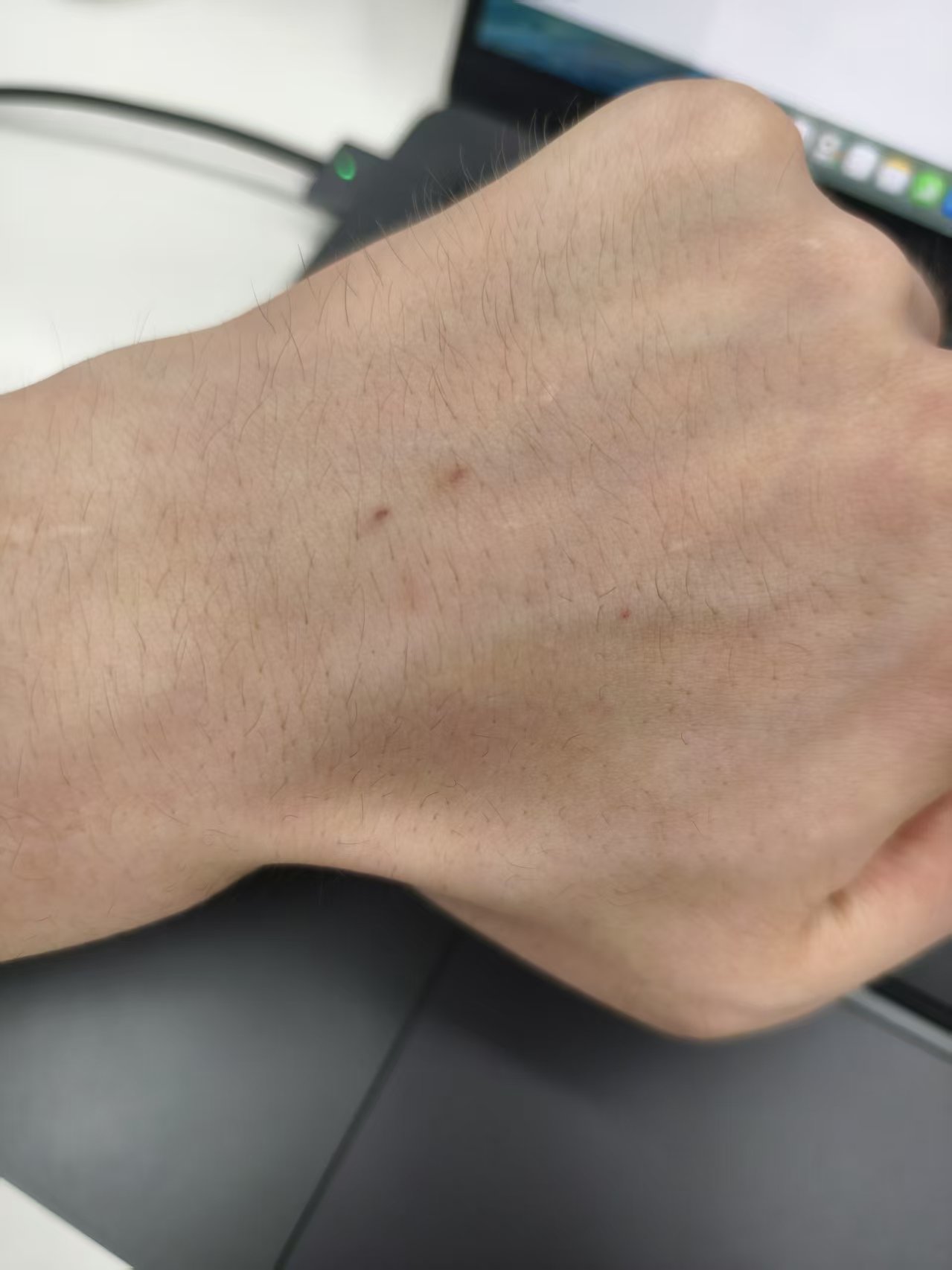 输液之后手背上留下的针眼和淤青。